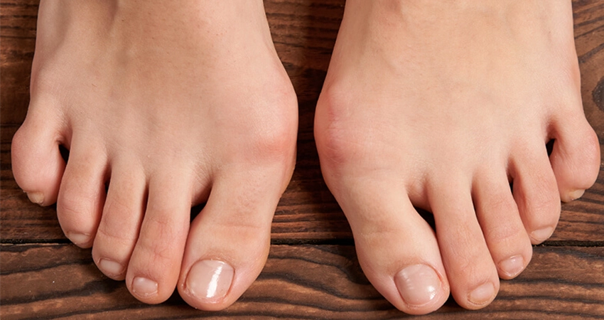 Schoenen hallux valgus dames cheap