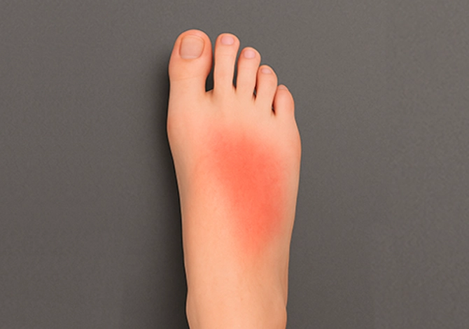 Gebroken middenvoetsbeentjes